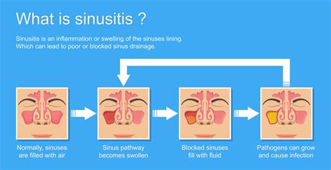 Sinusitis Kidshealth at Linda Redmon blog