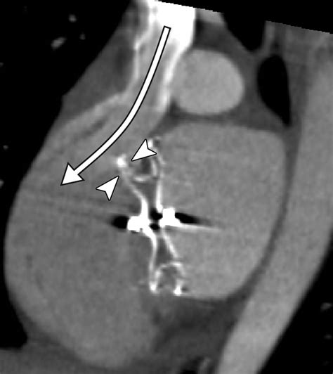 MDCT Evaluation After Closure of Atrial Septal Defect with an Amplatzer Septal Occluder | AJR