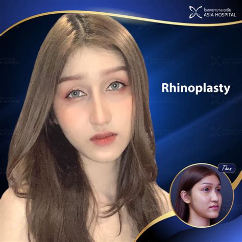 Thai Nose Job Rhinoplasty (nose Job) In Thailand – Costs And