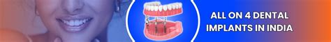 All on 4 Dental Implants in India: Cost, Benefits, and Considerations