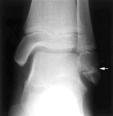 Lateral Malleolus Fracture Lateral Malleolus Fracture Treatment