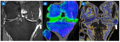 Identification of Non-Traumatic Bone Marrow Oedema: The Pearls and ...