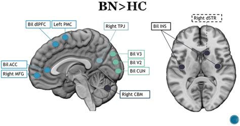 Brain Correlates of Eating Disorders in Response to Food Visual Stimuli ...