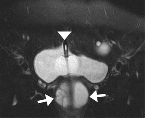 Urethral Diverticulum: Diagnosis with Virtual CT Urethroscopy | AJR