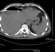 Drenaje abdominal guiado por TC | Centro Médico Teknon