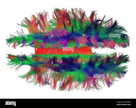 Image result for Diffuse Tensor Imaging