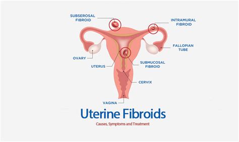 Uterine Fibroids | Ayushman Hospital and Health Services