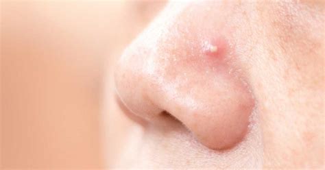 Image result for Big Zits Exploding at Home