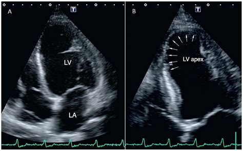Blocking Bug–Complete Atrioventricular Block in Chronic Chagas Disease