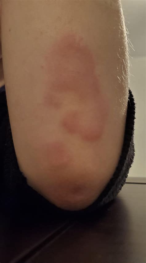 ringworm or eczema? : r/Dermatology
