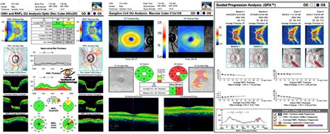 I Care Hospital & Phaco Center, Vadodara, Gujarat, India - Glaucoma Clinic