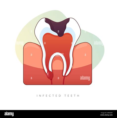 Root Canal Treatment On Infected Tooth at Joanne Magana blog