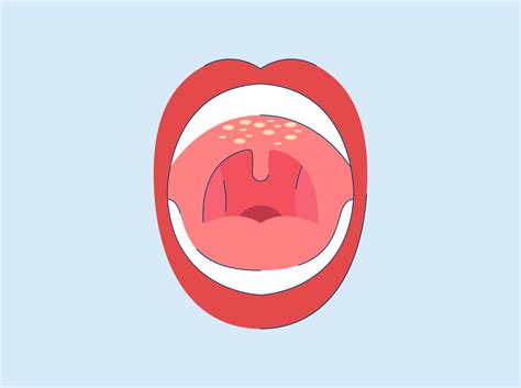 Why Does the Roof of My Mouth Hurt? Causes and Remedies
