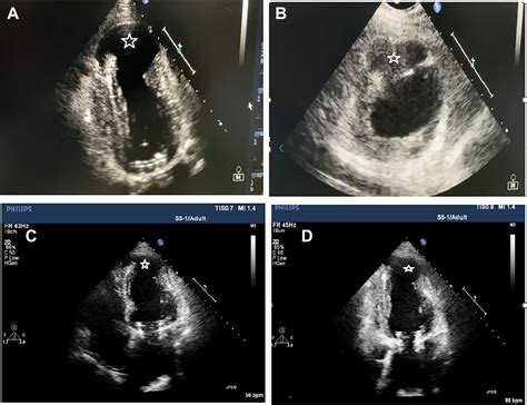 Conservative Management of an Iatrogenic Left Ventricular Aneurysm With ...