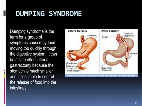 Image result for Colon Polyps Types