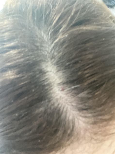 Dry Scalp Vs Lice Lice Vs Dandruff How To Tell Difference Between