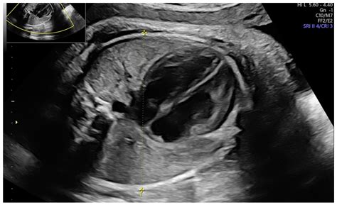 Accuracy of Fetal Biacromial Diameter and Derived Ultrasonographic ...