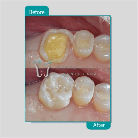 Dental Crown Material Types at Ruby Lay blog