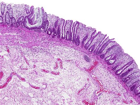 Serrated Polyposis Syndrome