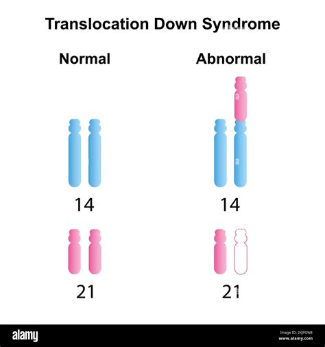 Translocation And Down Syndrome