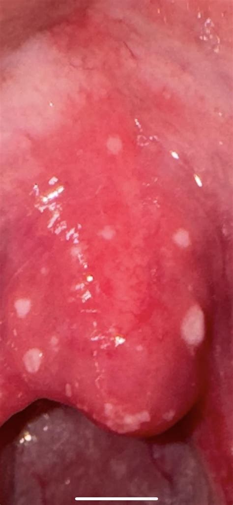 White spots on my Uvula and tonsil : r/AskDocs