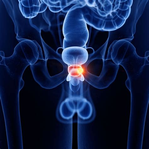 Therapieoptimierung beim Prostatakarzinom mittels Biomarkern - Urologie ...