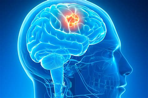 Brain Tumors: Causes, Symptoms, and Treatment Options