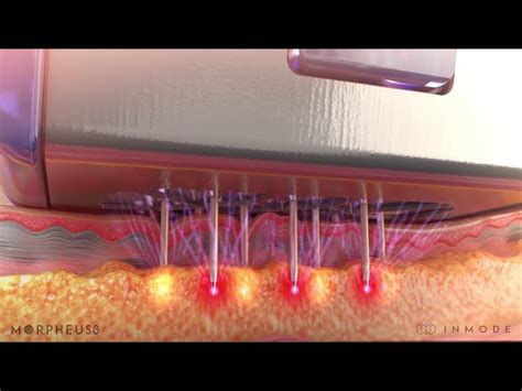Dermatology Equipment - Beauty Hydrafacial Machine Trader - Wholesaler ...