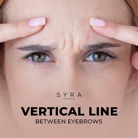 What Causes Vertical Lines Between Eyebrows at David Laramie blog