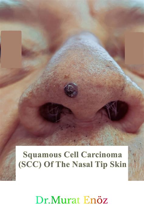 Squamous Cell Carcinoma (SCC) Of The Nasal Tip Skin