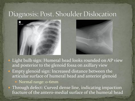 Image result for Posterior Shoulder Dislocation Sulcus Sign