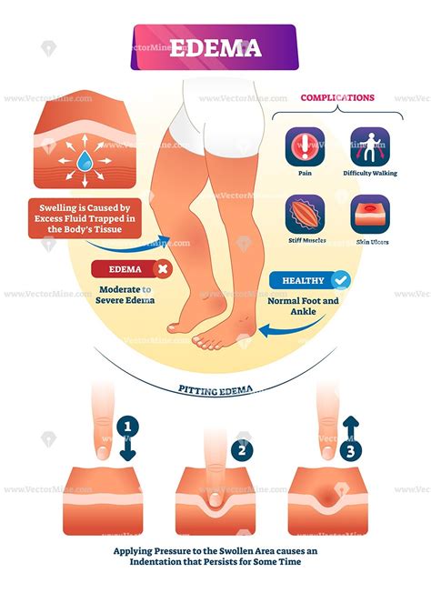 Edema skin condition vector illustration infographic diagram | Edema, Skin ulcer, Body tissues