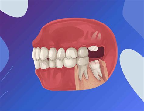 Wisdom Teeth Function 的图像结果