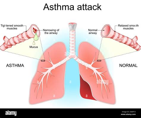 Asthma attack. Lungs, bronchi and airways. Close-up of a cross-section ...