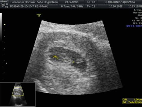 Podrían ayudarme a saber que es con el método ramzi? Es eco abdominal ...