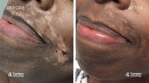 Vitiligo Before And After
