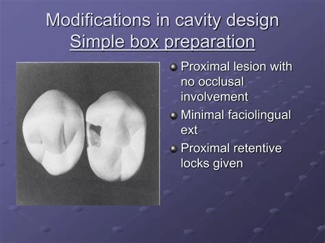 CLASS II tooth prep for SAF.ppt