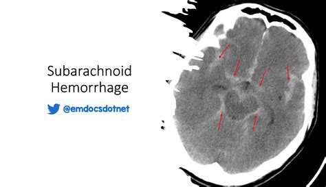Subarachnoid Hemorrhage