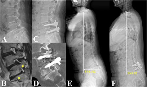 Exploring the impact of mild-to-moderate foraminal stenosis at L5−S1 on clinical outcomes ...
