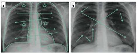 Lung Nodules Localization and Report Analysis from Computerized Tomography (CT) Scan Using a ...