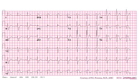 File:Brugada syndrome type1 example1.png - ECGpedia