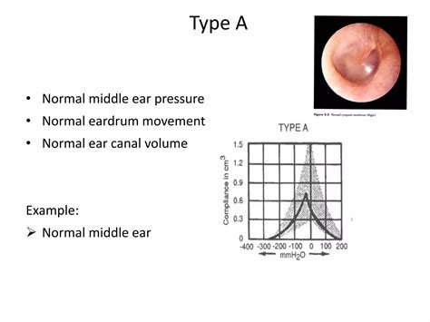 Tympanometry | PPTX