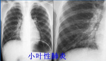八种常见肺炎的X线诊断