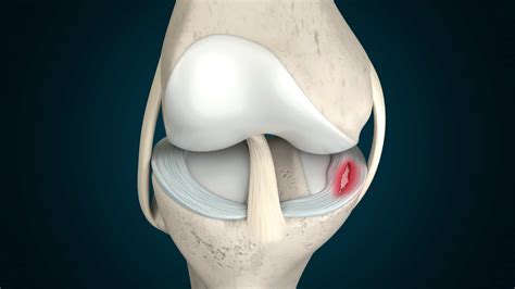 Meniscus Pain Symptoms