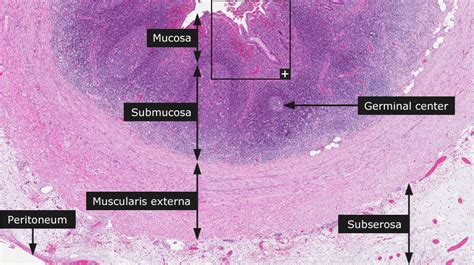 Image result for Normal Appendix Appearance