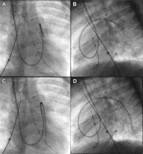 Pulmonary Artery Wedge Pressure Can Underestimate Direct Pulmonary Vein ...