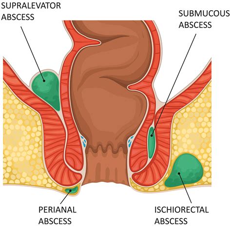Rectal Abscess Emedicine