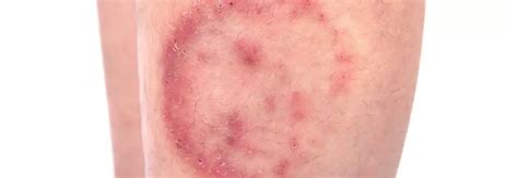 Antimicrobial blue light and quinine combo effective for treatment of ...