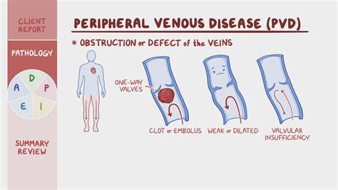 Video: Peripheral venous disease (PVD): Nursing process (ADPIE)