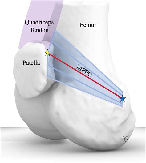 Medial Quadriceps Tendon Femoral Ligament Reconstruction for Anatomic ...
